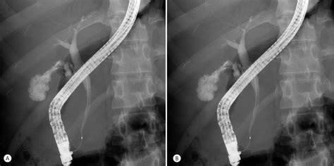 Endoscopic Retrograde Cholangiogram Showed Distal Common Bile Duct