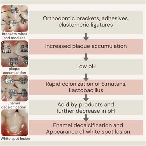 The Role Of Fluorides In White Spot Lesions During Orthodontic