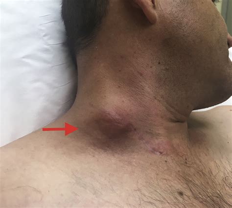 Cervical Tuberculous Lymphadenitis Journal Of Emergency Medicine