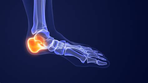 Plantar Fasciitis With Calcaneal Spur Symptoms Diagnosis Treatments