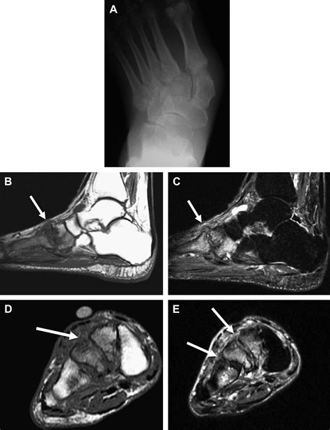 Mr Imaging Of Midfoot Injury Magnetic Resonance Imaging Clinics