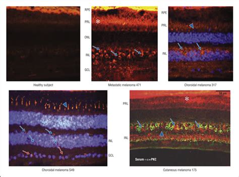 Melanoma Associated Retinopathy A Paraneoplastic Autoimmune Complication Ophthalmology Jama