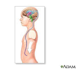 Ventriculoperitoneal Shunt Placement (Inpatient Care)