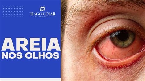 AREIA NOS OLHOS Como tratar a sensação Olho Seco YouTube