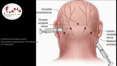 Greater Occipital Nerveblock Greateroccipital Nerve Headache Neckpain Neuralgia Painfixrx