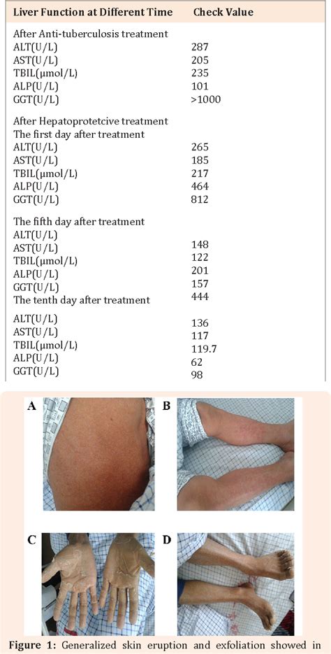 Figure From Severe Skin Rash And Liver Toxic Effects Caused By First