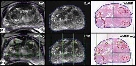 Representative Case Patient Year Old Male A In Vivo Mri