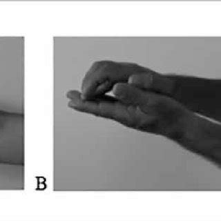 Atrophy of the right thenar eminence (arrow) and flexion contracture of ...