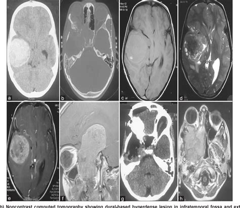 Figure From Extraosseous Primary Intracranial Ewing Sarcoma