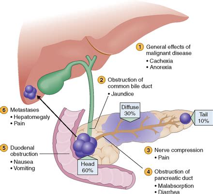 THE EXOCRINE PANCREAS | Basicmedical Key