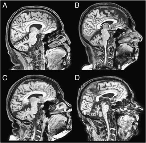 Structural MRI scans of SCA-6-induced cerebellar degeneration in four ...