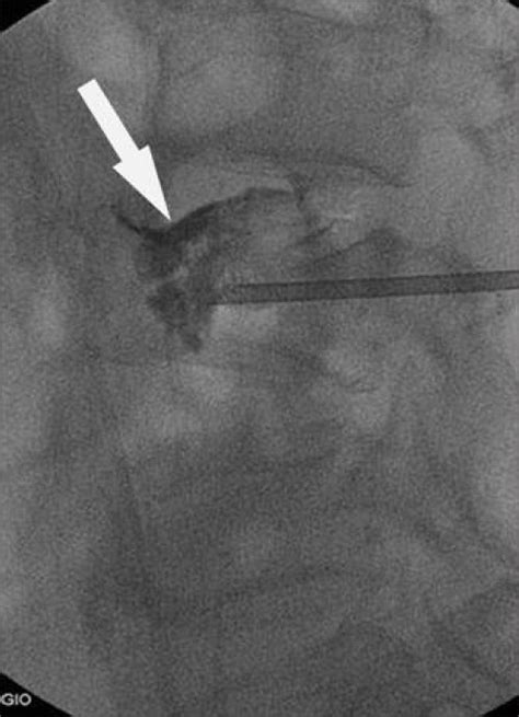 Lateral Fluoroscopic View In A Year Old Man With Osteoporotic