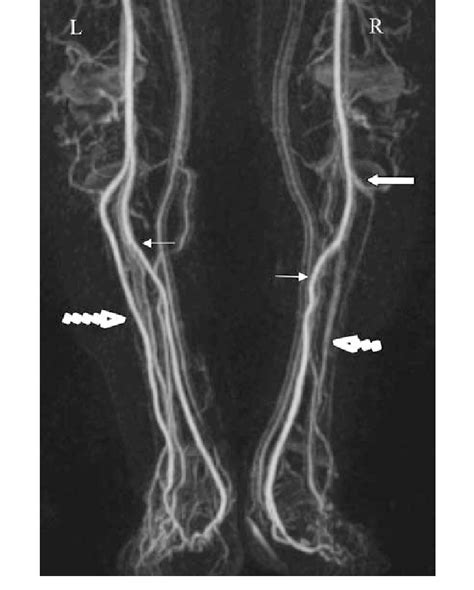 Lower Extremity Angiography