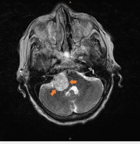 Axial T2 Turbo Spin Echo Tse Magnetic Resonance Imaging Mri Brain