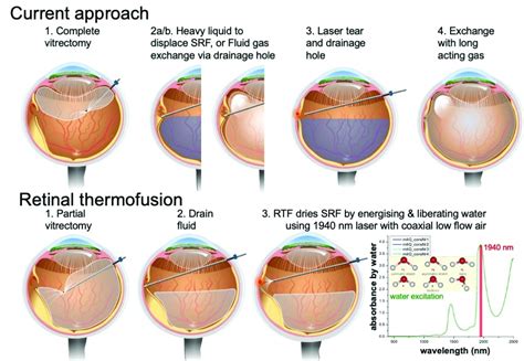 Retinal Detachment Treatment