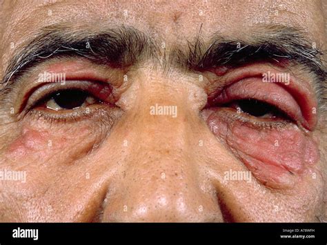 Allergic Contact Eczema Dermatitis Rash Fotografías E Imágenes De Alta Resolución Alamy