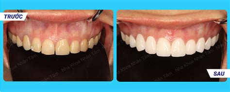 Smile Design Turkey Price Start 2 990 TL Best Price Best Quality