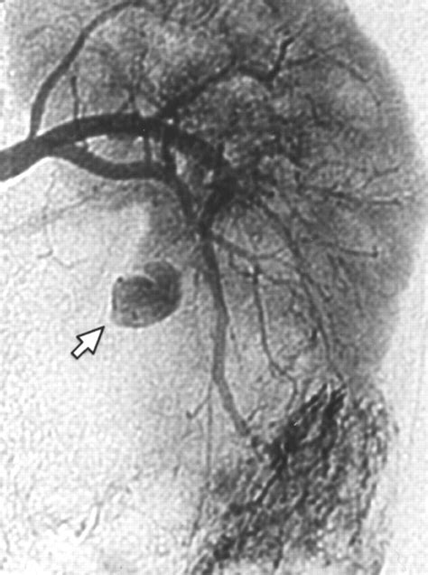 Renal Angiomyolipoma Gross