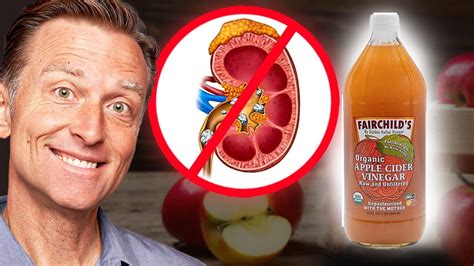 Use Apple Cider Vinegar To Dissolve Kidney Stones Youtube