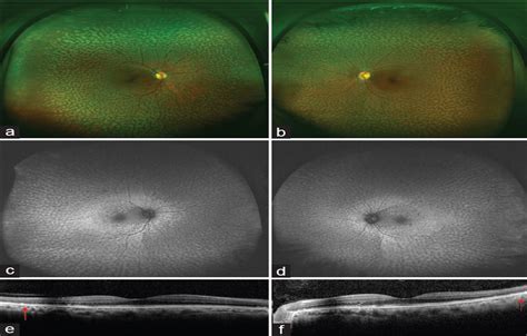 Multimodal Imaging In Familial Dominant Drusen Indian Journal Of