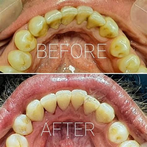 Teeth Scaling And Polishing Benefits Procedure And Aftercare