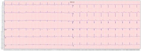 Examples of anteroseptal myocardial infarction (ASMI) | ECG Library