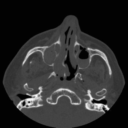 Le Fort Fracture Classification Radiology Reference Article