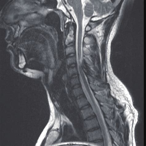 Sagittal T2 Weighted Mr Image Of The Cervical Spine Showing A Narrowed