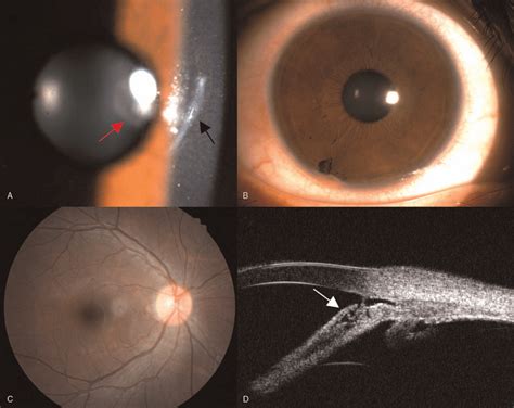 A The Slit Lamp Image Of The Anterior Segment On Initial Examination