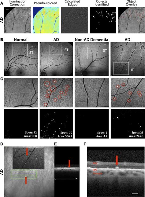 Jci Insight Retinal Amyloid Pathology And Proof Of Concept Imaging