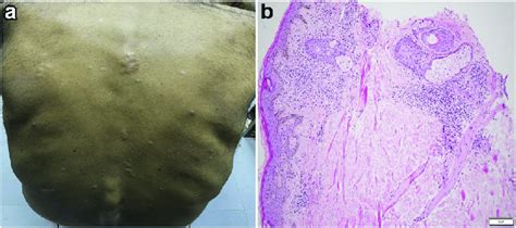 A Multiple Skin Colored Papules And Nodules Over Patient S Back Download Scientific