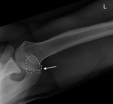 Axillary View Radiograph Of A Left Shoulder Defines The Neo Joint Line