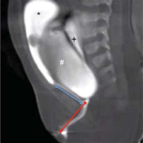 Classification Of Anorectal Malformations Wingspread