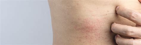 Skin Rash causes and symptoms