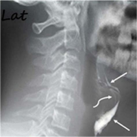 Lateral Lat Fistulography View Of The Neck The Arrows Show The