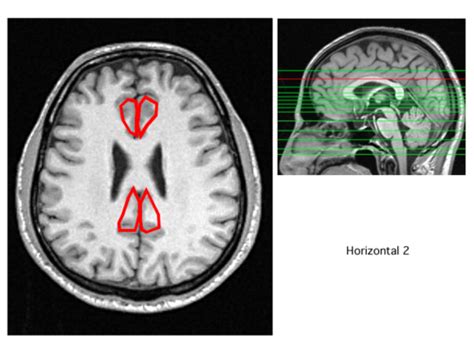 Mri Brain Flashcards Quizlet