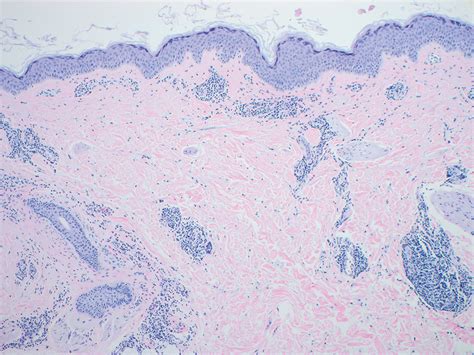 Annular Erythematous Plaques On The Back Mdedge Dermatology