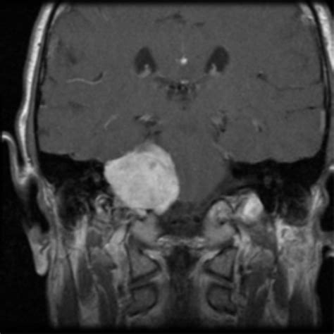 Acoustic Schwannoma Eroding Petrous Apex Image Radiopaedia Org