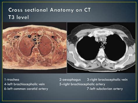 Ppt Imaging Anatomy Of The Mediastinum Powerpoint Presentation Id2075433