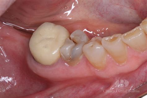 Restauraci N Y Protecci N De Un Segundo Premolar Inferior Derecho