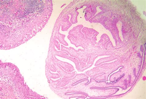 Histopathology Of Breast Cysticercosis Showing Cysticercosis With Three Download Scientific