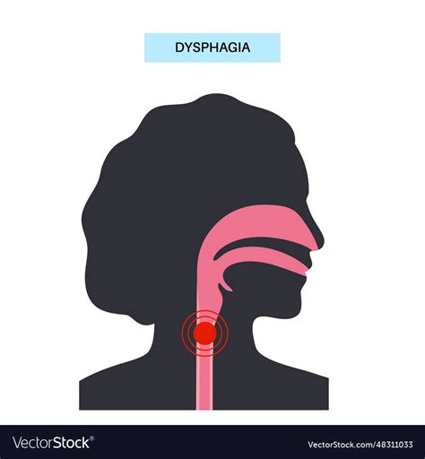 Dysphagia Medical Poster Royalty Free Vector Image