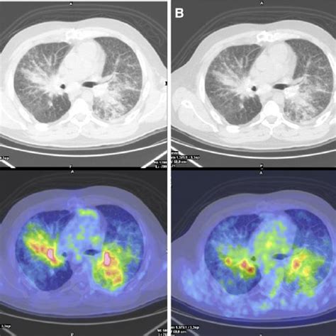 A On Admission Chest Computed Tomography Scan Revealed Bilateral