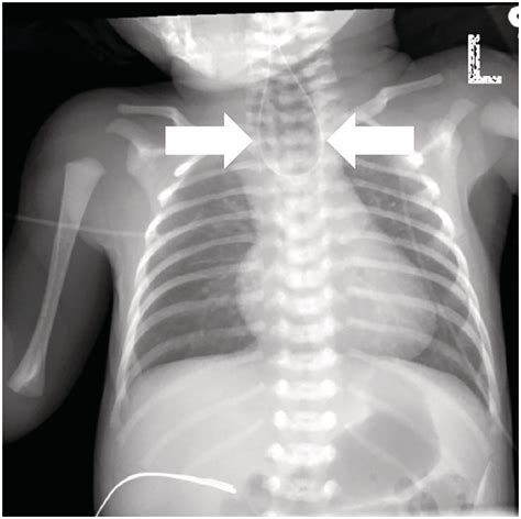 Chapter 20 – Esophageal Atresia and Tracheoesophageal Fistula | Anesthesia Key