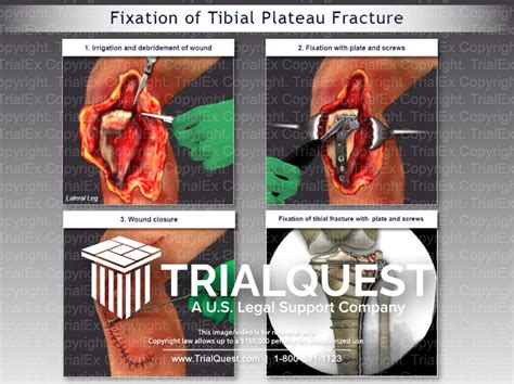 Fixation Of Tibial Plateau Fracture Trial Exhibits Inc