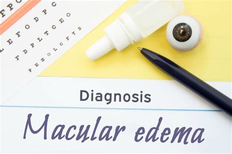 Macular Edema - Another Name for Macular Swelling