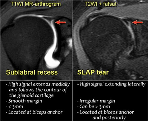 Mri Shoulder Labrum Tear