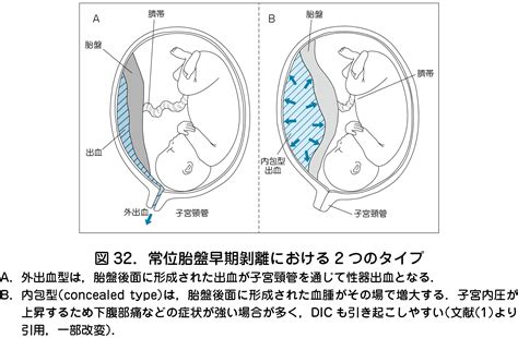 6常位胎盤早期剝離 日本産婦人科医会