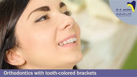 Orthodontics With Tooth Colored Brackets Dr Jamilian