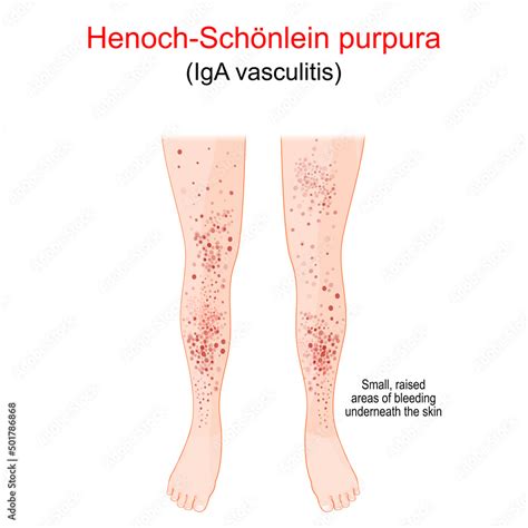 Henoch Schönlein purpura Spotty rash on the humans legs Stock Vector